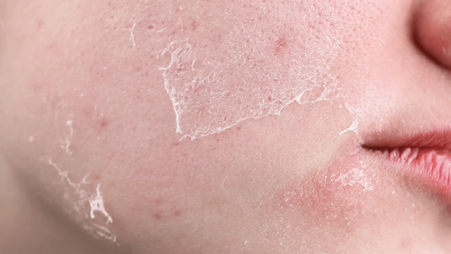 bai-viet/co-nen-tay-te-bao-chet-cho-da-mat-khong-mot-so-sai-lam-khi-tay-da-chet.html