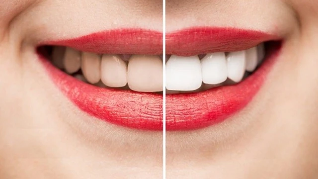 bai-viet/co-nen-tay-trang-rang-khong-chi-phi-bao-nhieu.html