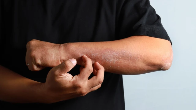 bai-viet/co-the-ban-can-biet-ve-7-loai-thuc-pham-de-gay-di-ung-voi-nguoi-viem-da-co-dia.html