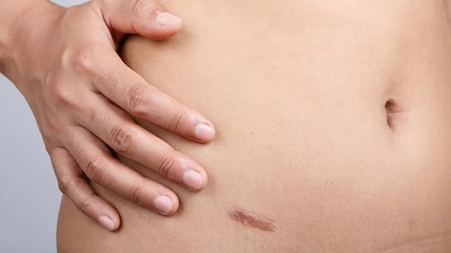 bai-viet/con-dau-bung-sau-mo-noi-soi-ruot-thua-co-nguy-hiem-khong.html