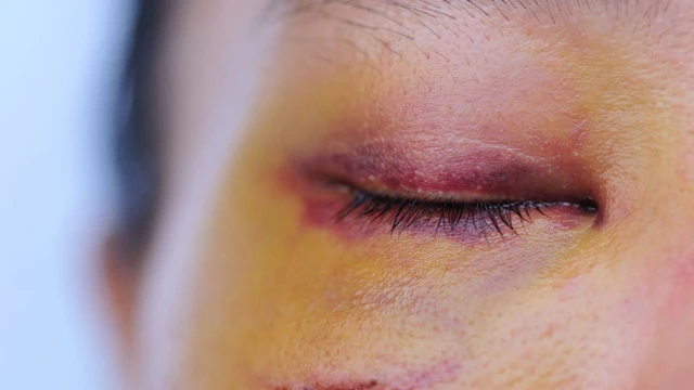 bai-viet/tu-nhien-bi-bam-tim-o-mat-la-do-dau-va-cach-khac-phuc.html