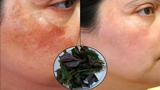 bai-viet/tham-khao-cach-tri-nam-tai-nha-hieu-qua-va-de-thuc-hien.html