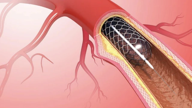 bai-viet/cuoc-song-sau-khi-dat-stent-mach-vanh-nhung-kho-khan-va-bien-phap-ho-tro.html