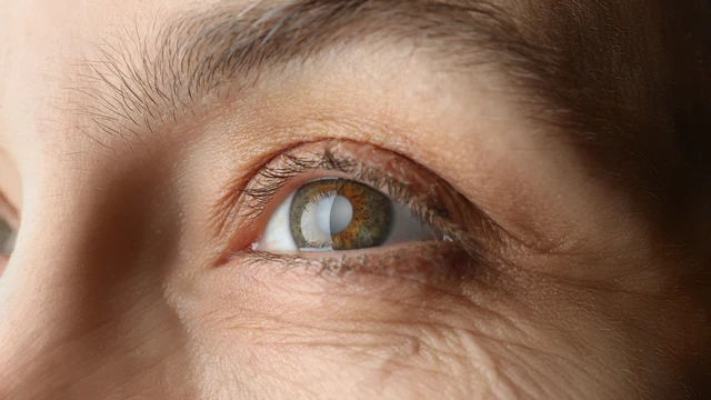 bai-viet/cuom-mat-la-gi-nguyen-nhan-trieu-chung-va-cach-dieu-tri-hieu-qua.html