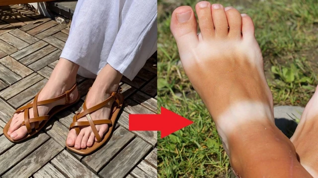 bai-viet/cach-cham-soc-da-bi-chay-nang-sam-den-khi-mua-he-toi.html