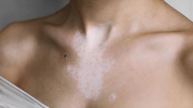 bai-viet/da-bi-mat-sac-to-phai-lam-sao.html