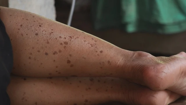 bai-viet/da-chan-bi-dom-nau-nguyen-nhan-cach-can-thiep-va-phong-ngua.html