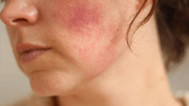 bai-viet/da-nhiem-corticoid-la-gi-soi-da-nhiem-corticoid-bang-may-co-chuan-xac-khong-71452.html