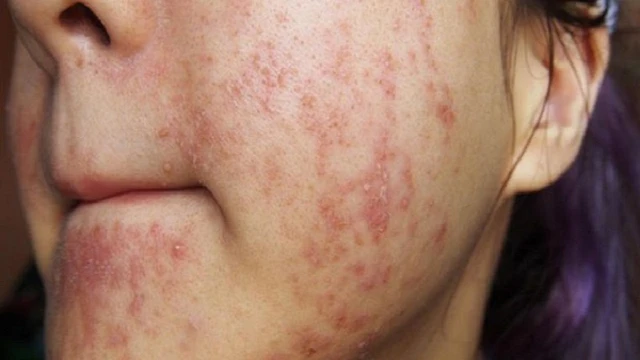 bai-viet/da-nhiem-corticoid-nen-an-gi-va-kieng-an-gi-de-nhanh-phuc-hoi.html