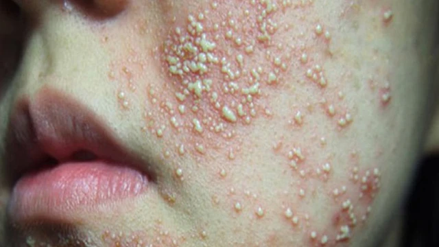 bai-viet/da-nhiem-corticoid-nhe-nen-lam-gi.html