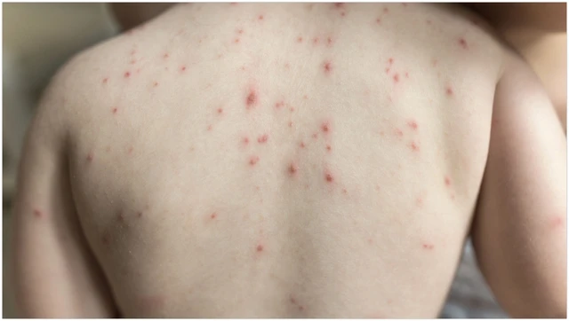 bai-viet/da-noi-nhung-hat-nho-khong-ngua-la-tinh-trang-gi.html