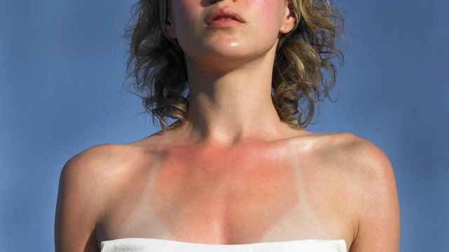 bai-viet/da-ram-nang-la-gi-cach-phuc-hoi-lan-da-ram-nang.html