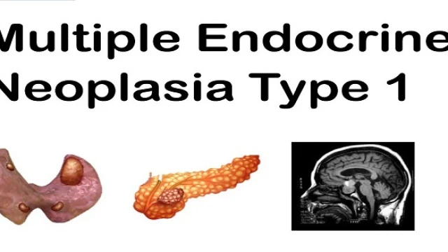 bai-viet/da-u-tuyen-noi-tiet-typ-1-men1-55545.html