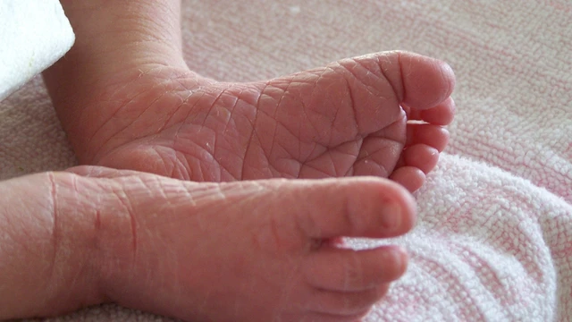 bai-viet/da-vay-ca-o-tre-so-sinh-nguyen-nhan-trieu-chung-chan-doan-va-dieu-tri.html