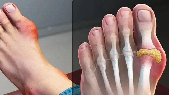 bai-viet/dac-diem-giai-doan-dau-cua-benh-gut-la-gi.html