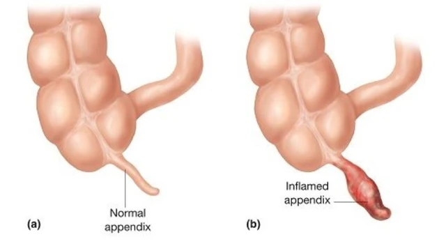 bai-viet/dam-quanh-ruot-thua-va-nhung-dieu-can-biet.html
