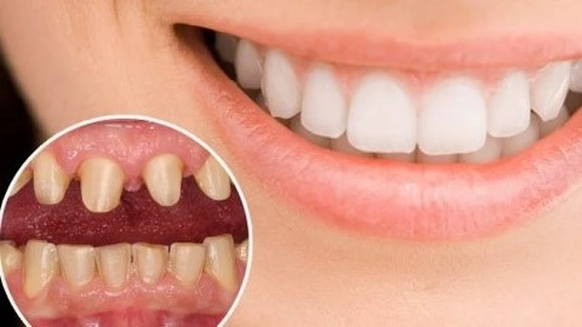 bai-viet/giai-dap-thac-mac-dan-su-veneer-co-anh-huong-gi-khong-63766.html