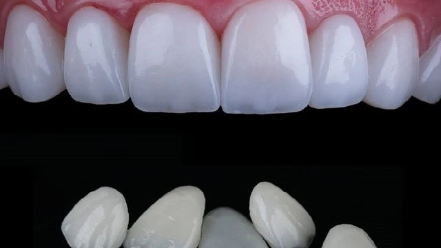 bai-viet/dan-su-veneer-diamond-co-tot-khong-chi-phi-the-nao-63750.html