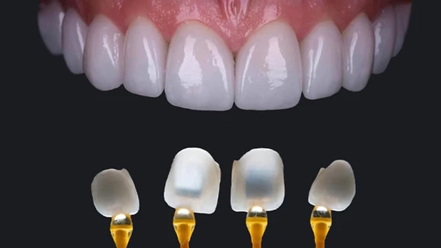 bai-viet/dan-su-veneer-la-gi-dan-su-veneer-co-ben-khong-64514.html