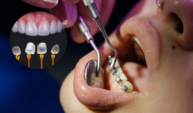 bai-viet/dan-veneer-co-nieng-rang-duoc-khong-dan-veneer-hay-boc-su-tot-hon-63697.html