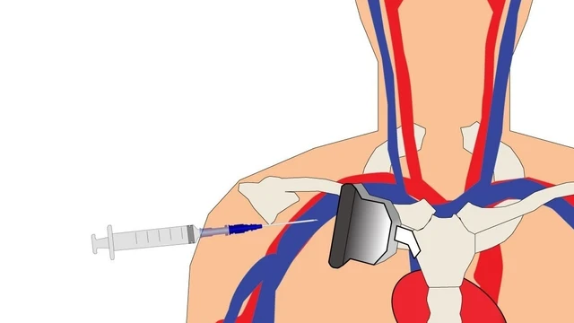 bai-viet/tim-hieu-chi-tiet-ve-dat-catheter-tinh-mach-duoi-don.html