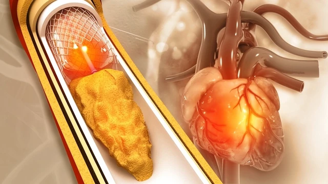 bai-viet/dat-stent-mach-vanh-va-nhung-dieu-can-biet.html