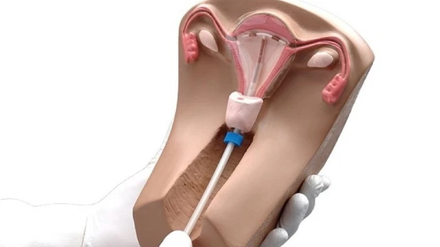 bai-viet/dat-vong-tranh-thai-co-dung-duoc-coc-nguyet-san-khong-62943.html