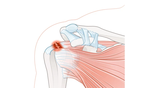 benh/dau-ba-vai.html