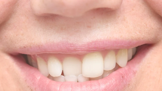 bai-viet/dau-hieu-moc-rang-khenh-dep-la-gi-cac-ky-thuat-chinh-nha-cho-rang-khenh.html