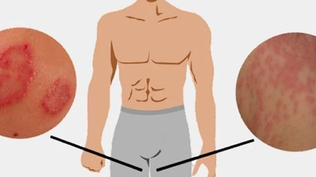 bai-viet/dau-hieu-nhan-biet-bi-hac-lao-o-hang-nguyen-nhan-va-cach-chua-tri-hieu-qua-55464.html