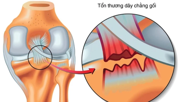 bai-viet/dau-hieu-dut-day-chang-cheo-truoc-ma-ban-nen-biet.html