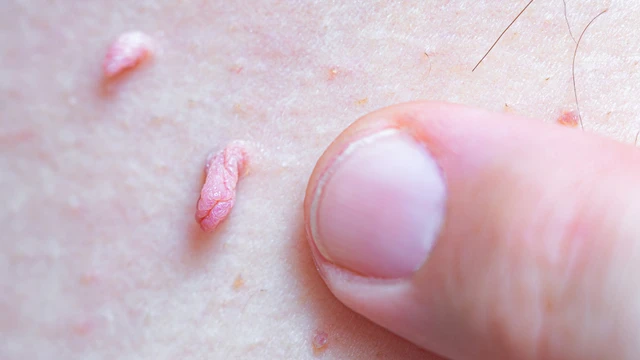 bai-viet/dau-hieu-nhan-biet-sui-mao-ga-giai-doan-dau-va-cach-xu-ly-som.html