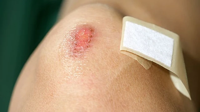 bai-viet/dau-hieu-nhiem-trung-vet-thuong-ma-ban-can-luu-y-64694.html