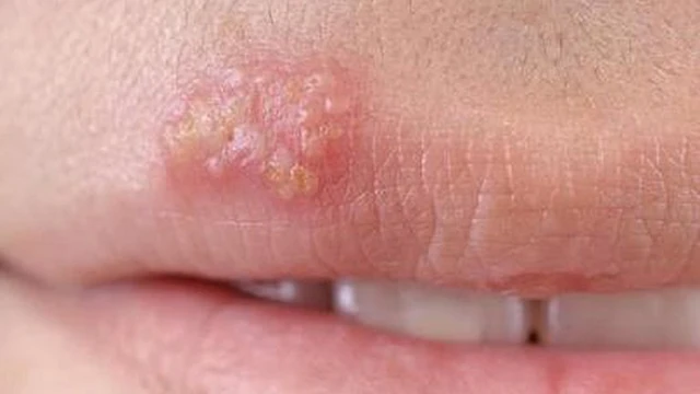 bai-viet/dau-hieu-noi-mun-nuoc-o-moi-la-gi-co-phong-ngua-duoc-khong-58318.html