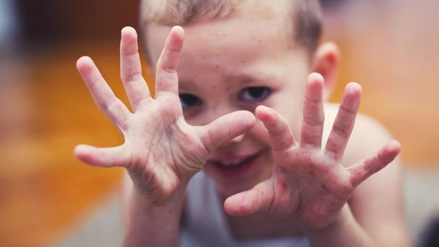 bai-viet/dau-hieu-tay-chan-mieng-la-gi-bien-phap-phong-ngua-benh-tay-chan-mieng.html