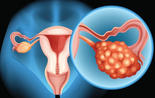 bai-viet/dau-hieu-ung-thu-buong-trung-ma-ban-nen-biet.html