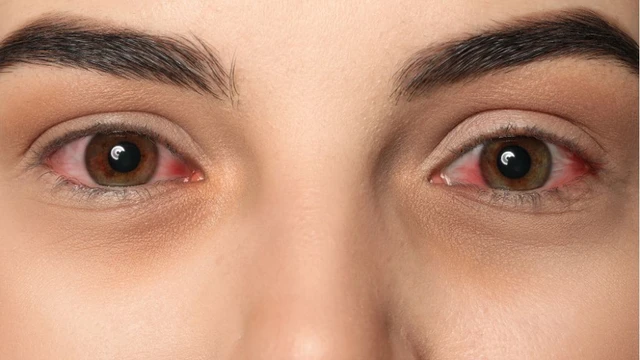 bai-viet/dau-mat-do-lau-ngay-khong-khoi-nguyen-nhan.html