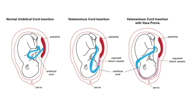 benh/day-ron-bam-mang.html