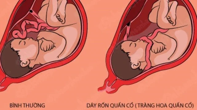 bai-viet/day-ron-quan-co-2-vong-la-gi-meo-dan-gian-chua-day-ron-quan-co-63825.html