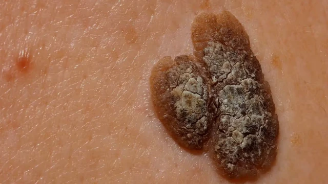 bai-viet/benh-day-sung-da-dau-nguyen-nhan-trieu-chung-va-cach-dieu-tri.html