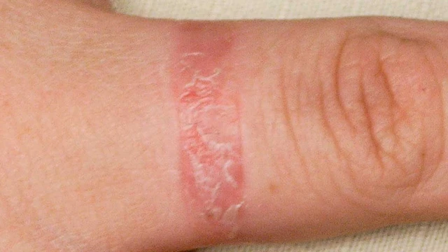 bai-viet/di-ung-bang-dinh-y-te-bieu-hien-nhu-the-nao-va-cach-khac-phuc-61496.html