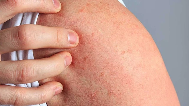 bai-viet/di-ung-nuoc-bien-dau-hieu-nhan-biet-va-cach-xu-ly.html