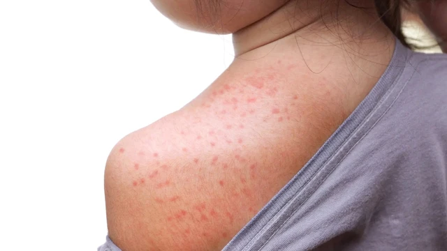 bai-viet/di-ung-thoi-tiet-nong-noi-man-do-nguyen-nhan-va-cach-dieu-tri.html