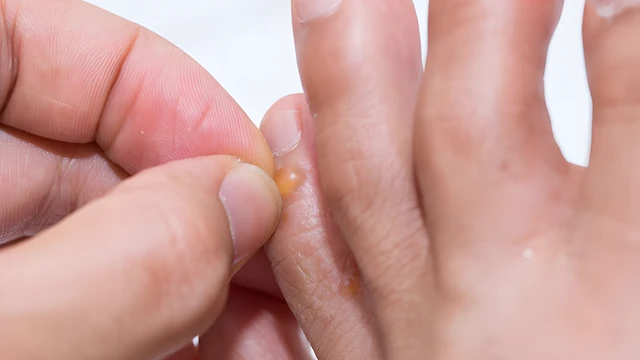 bai-viet/nhung-nguyen-nhan-gay-mun-nuoc-o-ngon-chan-ma-ban-can-luu-y.html