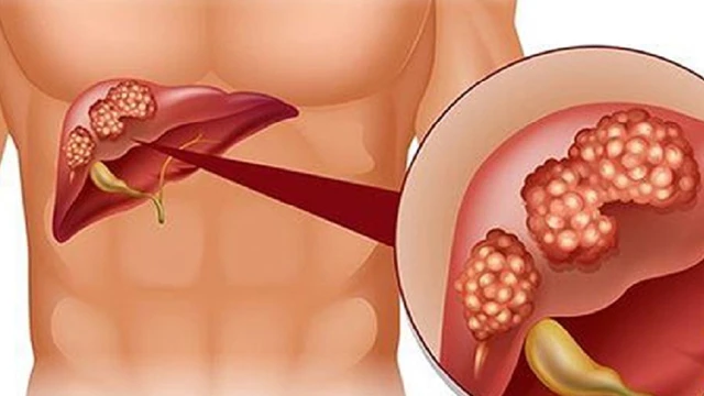 bai-viet/diem-mat-cac-nguyen-nhan-gay-xo-gan-ma-ban-can-biet-71810.html