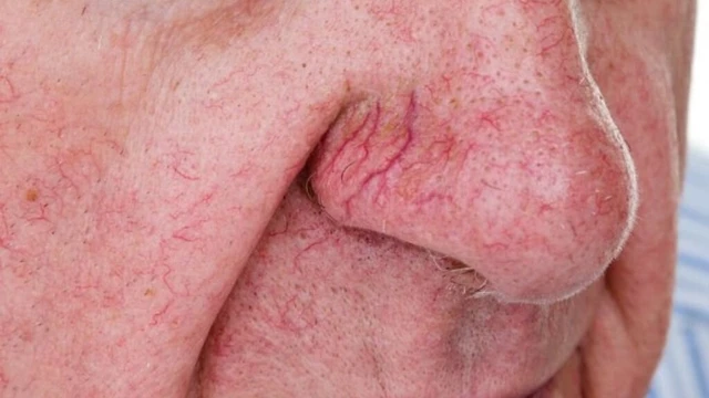 bai-viet/dieu-tri-gian-mao-mach-mui-nhu-the-nao.html