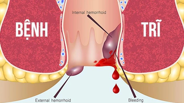 bai-viet/nhung-dieu-can-biet-ve-phuong-phap-that-tri-bang-vong-cao-su.html