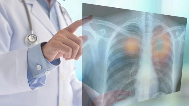 Ung thư phổi giai đoạn 3: Triệu chứng và cách điều trị