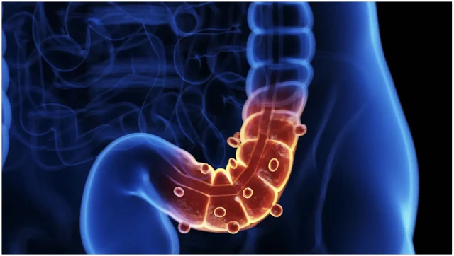 bai-viet/diverticulitis-la-gi-nguyen-nhan-trieu-chung-cach-chan-doan-va-dieu-tri.html