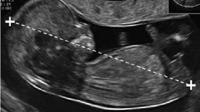 bai-viet/do-mo-da-gay-1-8mm-co-binh-thuong-khong.html